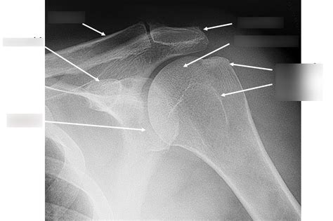 Shoulder Radiograph Ap External Rotation Diagram Quizlet