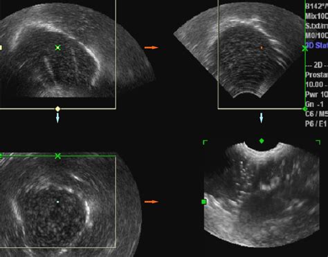 Prostate Biopsies Guided By Three Dimensional Real Time D