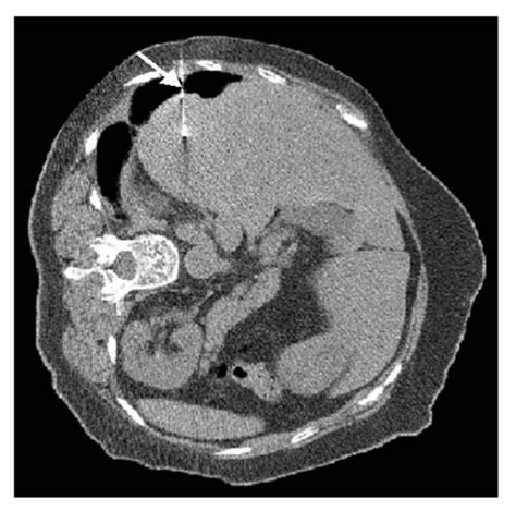 Percutaneous Needle Biopsy Of The Mass The Biopsy Needle Penetrated