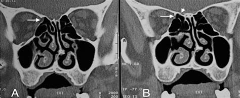 Figure 1 From The Relationship Between Ethmoidal Foramina And Orbital