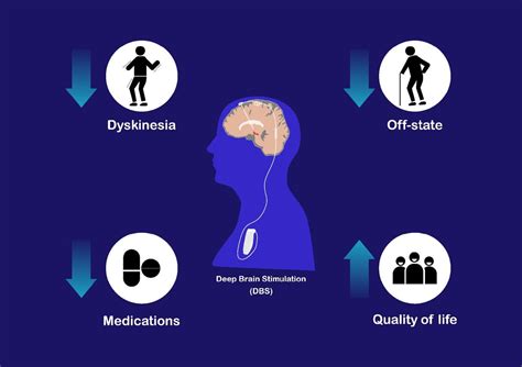 Concepts Of Deep Brain Stimulation For Treatment Of Parkinson S Disease