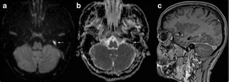 Clinical Applications Of Diffusion Weighted Imaging In Neuroradiology