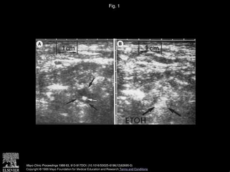 Persistent Primary Hyperparathyroidism Successful Ultrasound Guided