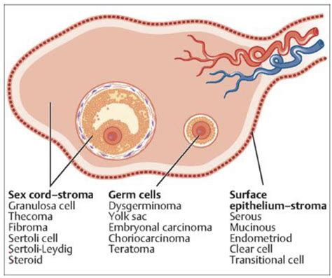 Ovarian Tumors Flashcards Quizlet