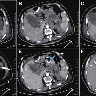 Ct Images Of The Abdomen In Patient A An Initial Ct Scan Shows