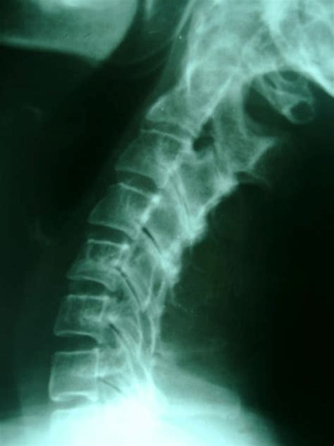 Lateral Cervical Views For Patient With Frank Congenital Short Neck