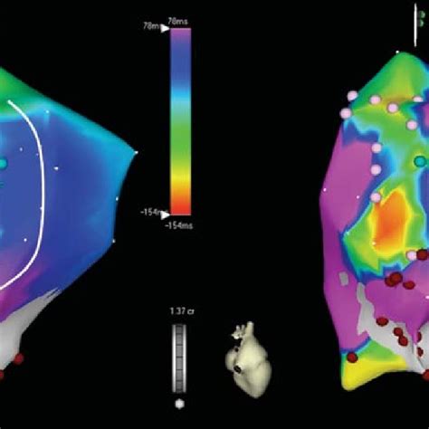 This Figure Shows Electroanatomic Maps In A Patient With Iart Post