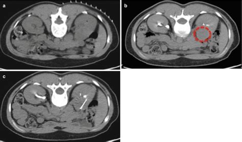 Renal Mass Biopsy | Radiology Key