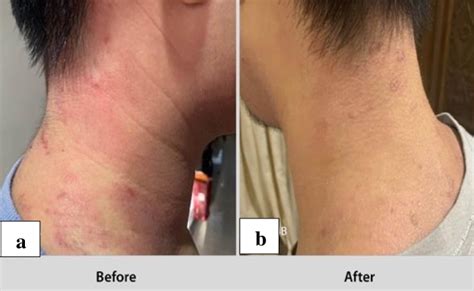 Patients With Large Patches Of Eczema On Both Scapulae A Posterior