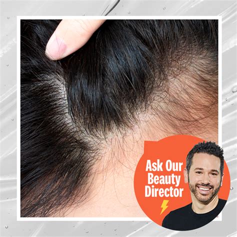 Does Ozempic Cause Hair Loss Experts Explain