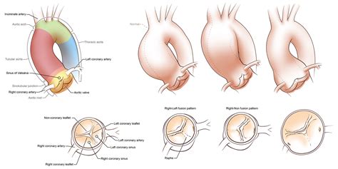 Bicuspid Aortic Valve And Aortic Aneurysm Behance