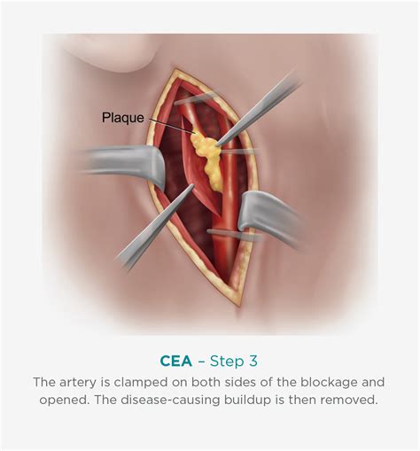 Carotid Intervention TCAR Procedure Benefits Recovery