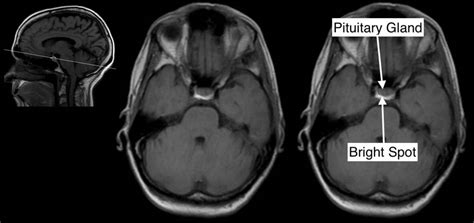 Radiological Anatomy Pituitary Gland Stepwards