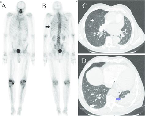 Whole Body M Tc Mdp Bone Scan Of A Patient With Breast Cancer Showed