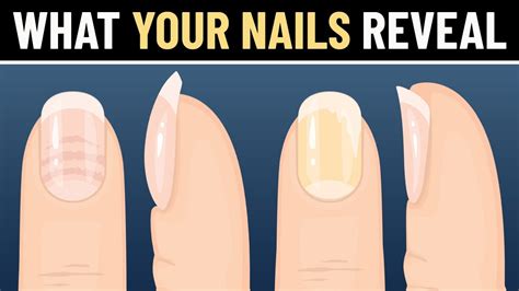 10 Things Your Nails Reveal About Your Health Youtube