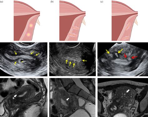 Uterine Junctional Zone And Adenomyosis Comparison Of Mri