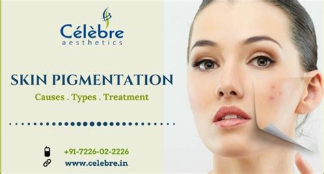 Skin Pigmentation : Causes, Types and Treatment