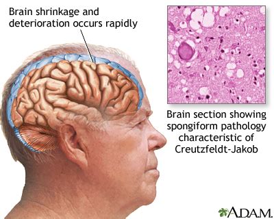 Creutzfeldt-Jakob disease | UF Health, University of Florida Health