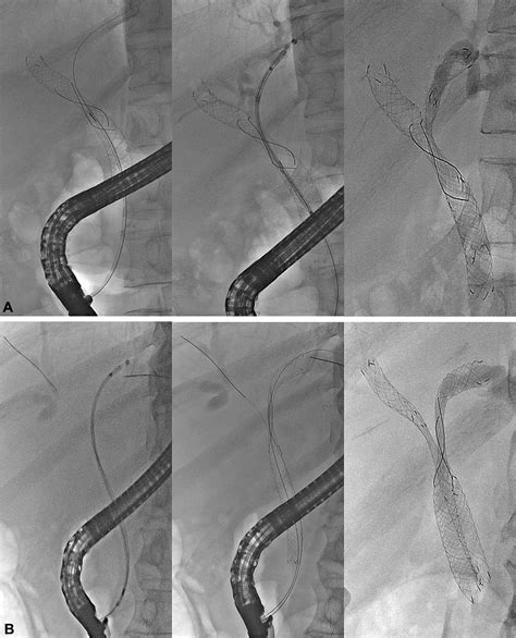 Prospective Comparison Of Endoscopic Bilateral Stent In Stent Versus