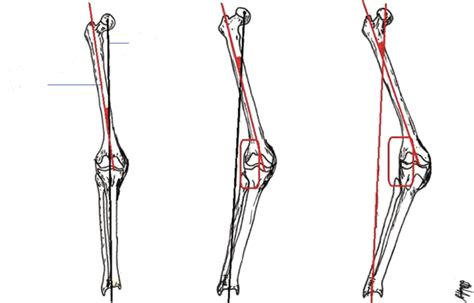 Mechanical And Anatomical Axis Of The Normal And Valgus Knee With