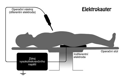 Elektrokauter – WikiSkripta