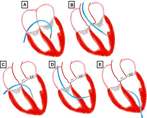 Best Practices For The Catheter Ablation Of Ventricular Arrhythmias