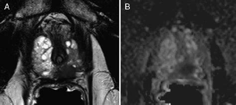 Restricted Diffusion Within A Prostate Cancer T2 Weighted Scan