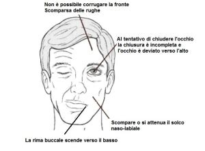 Nervo facciale anatomia vulnerabilità e paralisi di Bell CroSystem