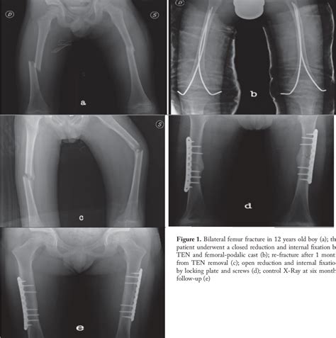 Figure From Locking Plate Fixation In Pediatric Femur Fracture