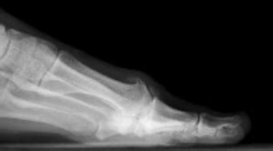 Hallux Rigidus | Travis J. Kemp, M.D. | Boise, ID