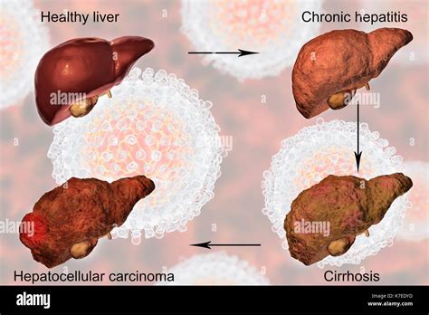 Stages of liver disease in hepatitis c hi-res stock photography and images - Alamy