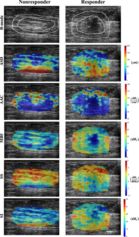 Transfer Learning Of Pre Treatment Quantitative Ultrasound Multi