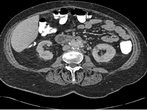 Hemorrhoids, Urinary and Blood Infections in a Woman With Rigors - Page 3