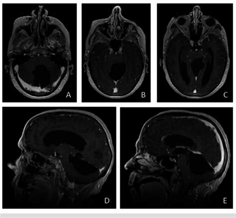 Preoperative Mri Scans Axial A C And Sagittal D E T Weighted Brain