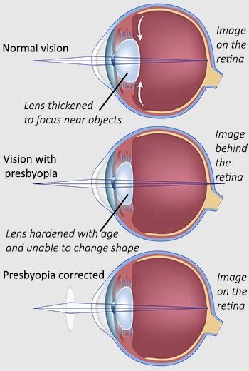 At What Age Is Presbyopia More Common And Why Presbyopia Eye Anatomy