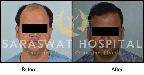 Hair Transplantation Before And After Results Saraswat Hospital