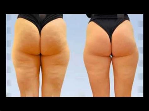 крем антицеллюлитный до и после - YouTube
