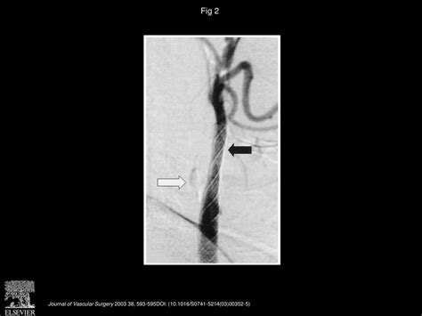 Endovascular Treatment Of Carotid Stump Syndrome Ppt Download