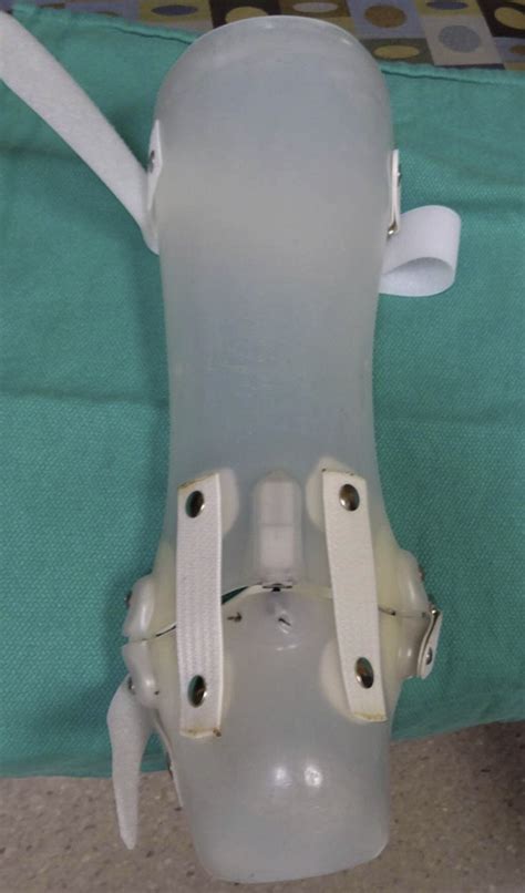 Minimally Invasive Soft Tissue Release Of Foot And Ankle Contracture