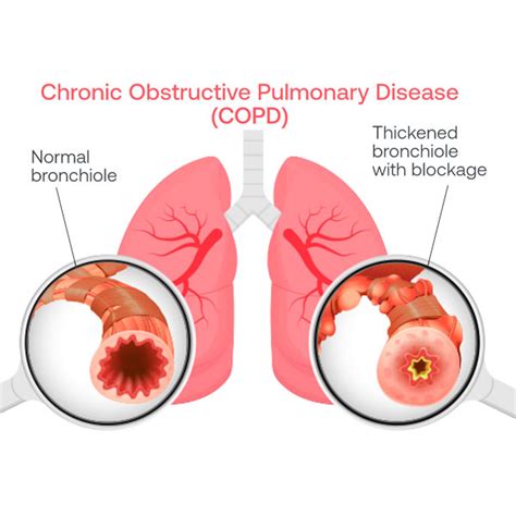 Lung Crackles or 🧨Fireworks 🧨? - Eko Health