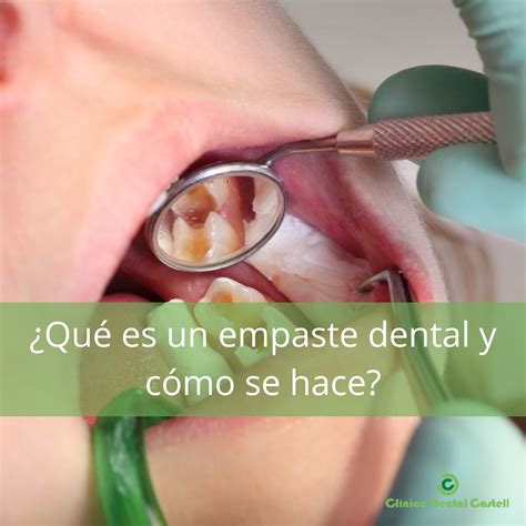 ¿qué Es Un Empaste Dental Y Cómo Se Hace Clínica Castell