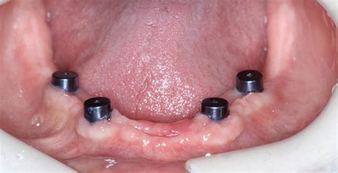 Upper And Lower Implant Overdentures Total Implants Male