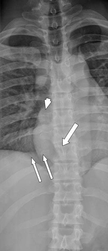 Ap Thoracic Spine Demonstrates Multiple Bony Erosions Associated With Download Scientific