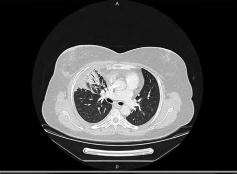 Computed Tomography Scan Of The Chest Showing Radiation Induced Lung