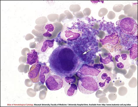 Chronic Myeloid Leukaemia CML BCR ABL1 Positive Chronic Phase