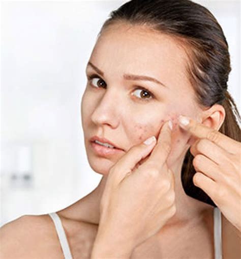 Причины акне и лечение угревой сыпи | Как лечить угри