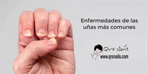 Enfermedades de las Uñas más Comunes