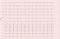 Abbildungen Und Graphiken EKG Beispiel Infarktdiagnostik Bei