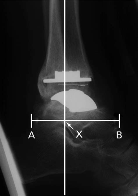 Total Ankle Replacement Bone And Joint