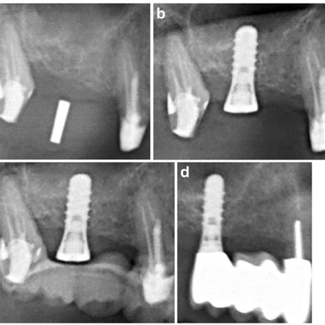 Radiographs Showing Measurements Of Bone Heights Bone Edges Marginal